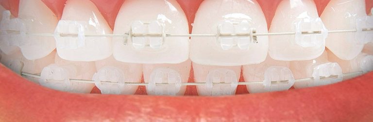 ortodoncia personalizada comoda mejor dentista acedo seseña dental avila brackets ceramicos