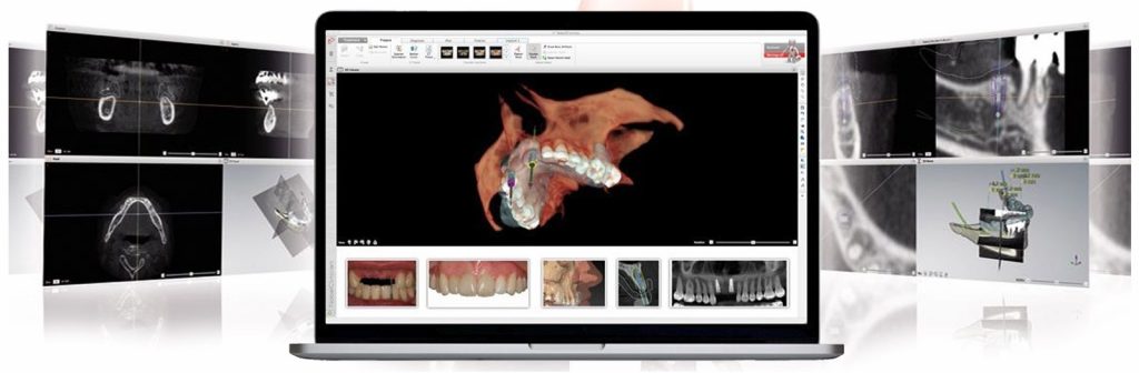 Implantes dentales Seseña Avila Dentista Clínica Acedo