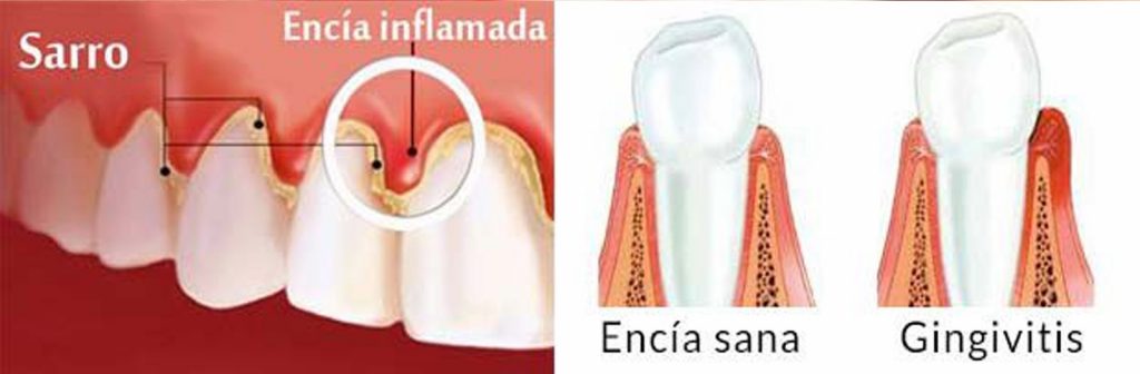 Periodoncia. Eliminar sarro y bacterias. Prevención de la gingivitis y periodontitis.