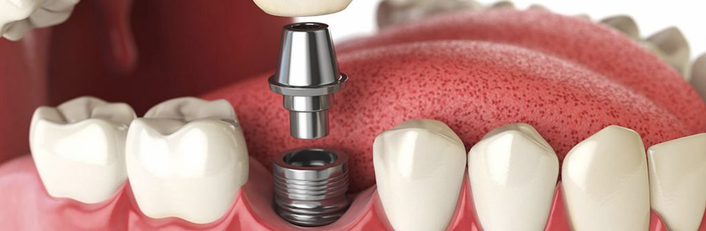 Implantes dentales Seseña Avila Dentista Clínica Acedo