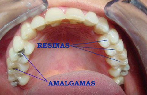 Obturaciones Odontología conservadora Acedo Seseña Dentista Ávila Avila