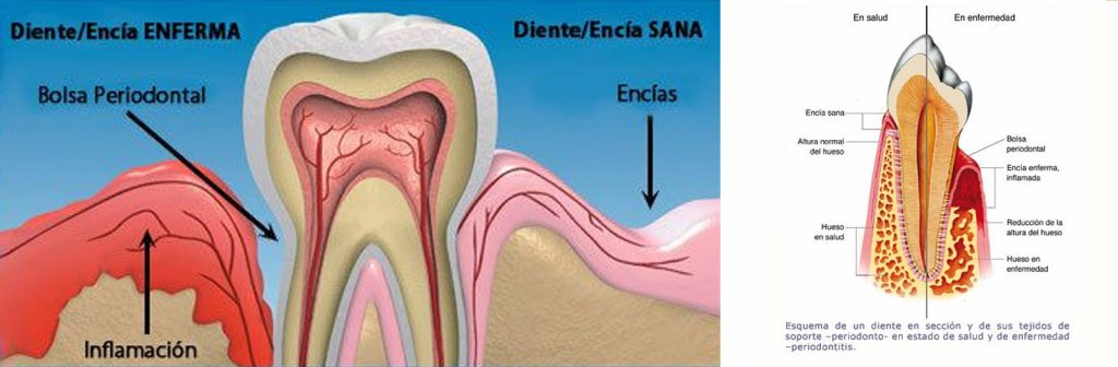 Periodoncia. Eliminar sarro y bacterias. Prevención de la gingivitis y periodontitis.