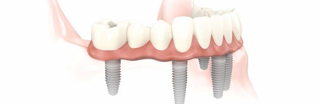 Implantes dentales Seseña Avila Dentista Clínica Acedo