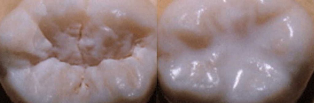 Niños infantil dentista odontopediatría odontopediatra mejor limpieza caries prevencion selladores