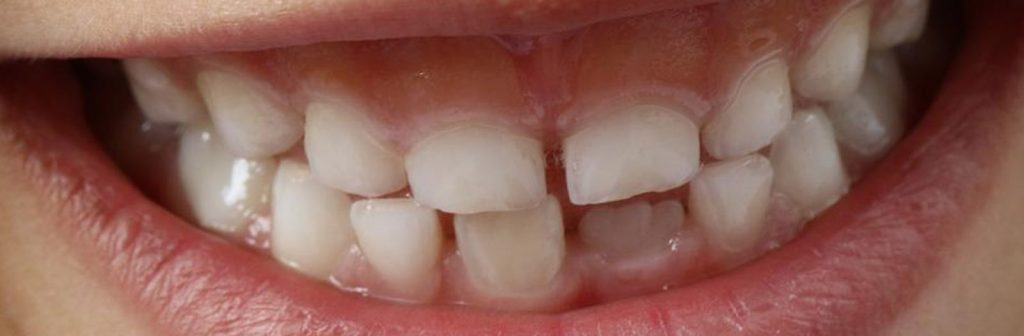 Niños infantil dentista odontopediatría odontopediatra mejor limpieza