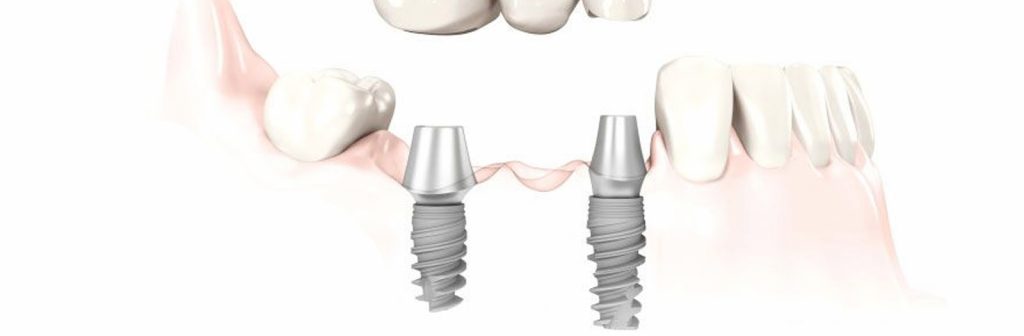 Implantes dentales Seseña Avila Dentista Clínica Acedo