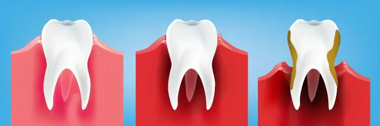 gingivorragia tratada en clínica dental acedo