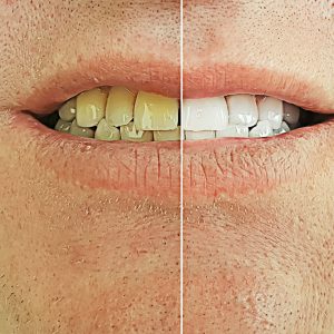 dientes manchas
