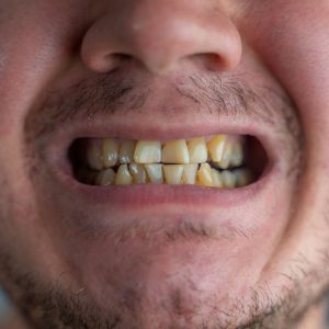 manchas en los dientes