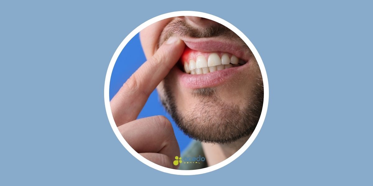 enfermedad periodontal tratamiento seseña