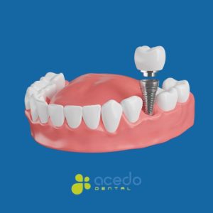 ventajas del implante dental