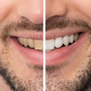 blanqueamiento dental en seseña