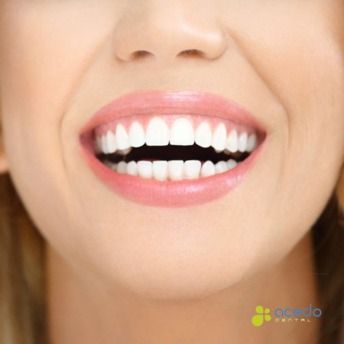 estética dental para novias