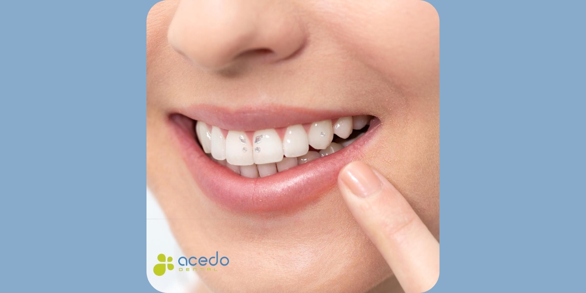Joya dental Clinica dental Acedo Seseña Toledo Dentistas Profesionales