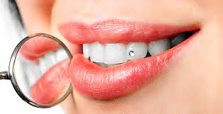 joya dental en clínica dental acedo