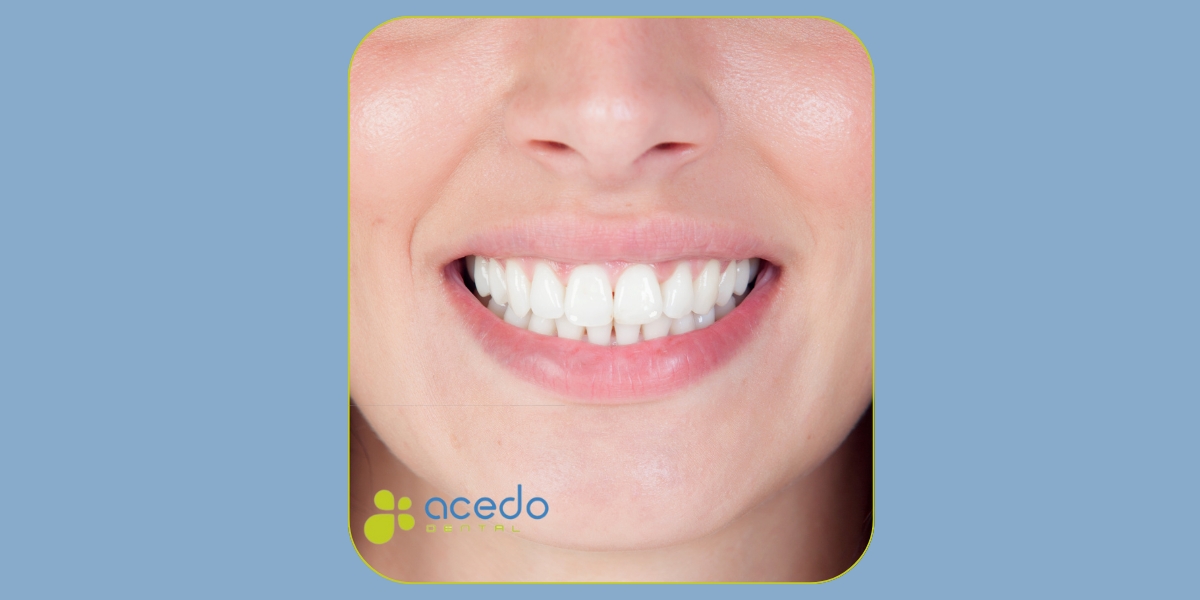 manchas blancas en los dientes Acedo Dental Dentista en avila dentista en seseña