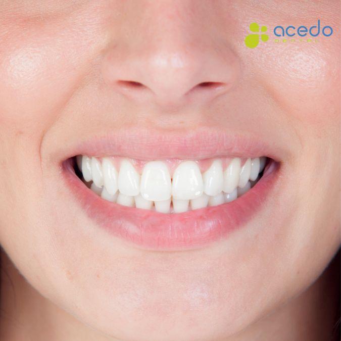causa manchas blancas en los dientes