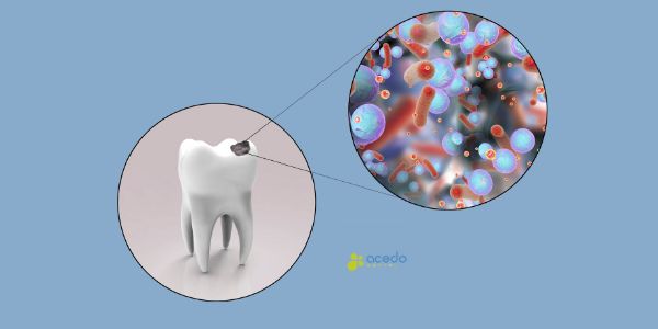 Como quitar las caries Acedo Seseña Dentista