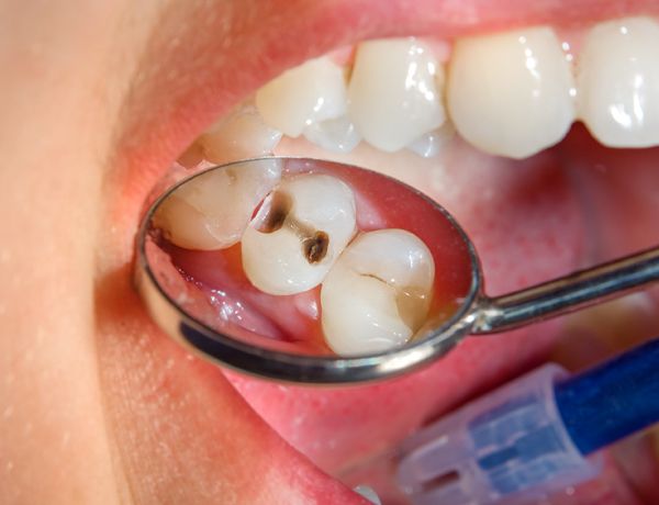 tratamiento caries dentales en clínica dental acedo