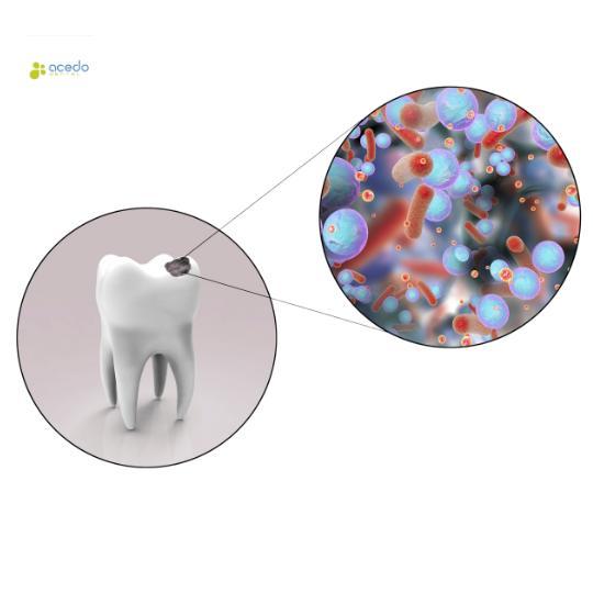 como quitar las caries Acedo Dental Seseña Dentista