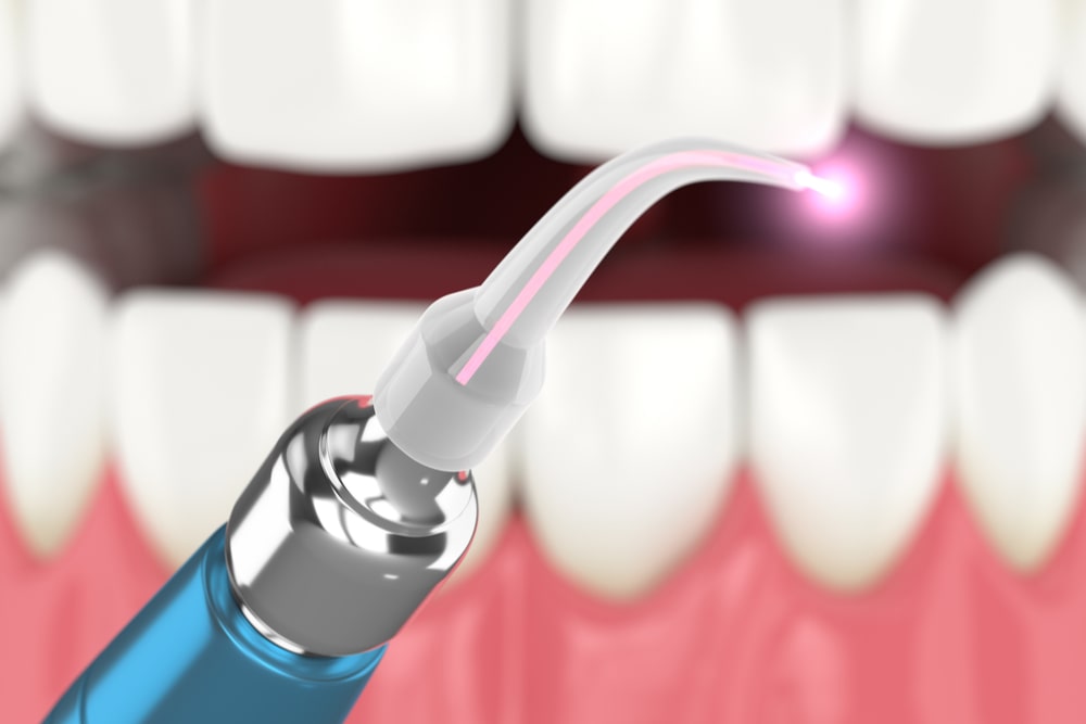 láser en tratamientos dentales