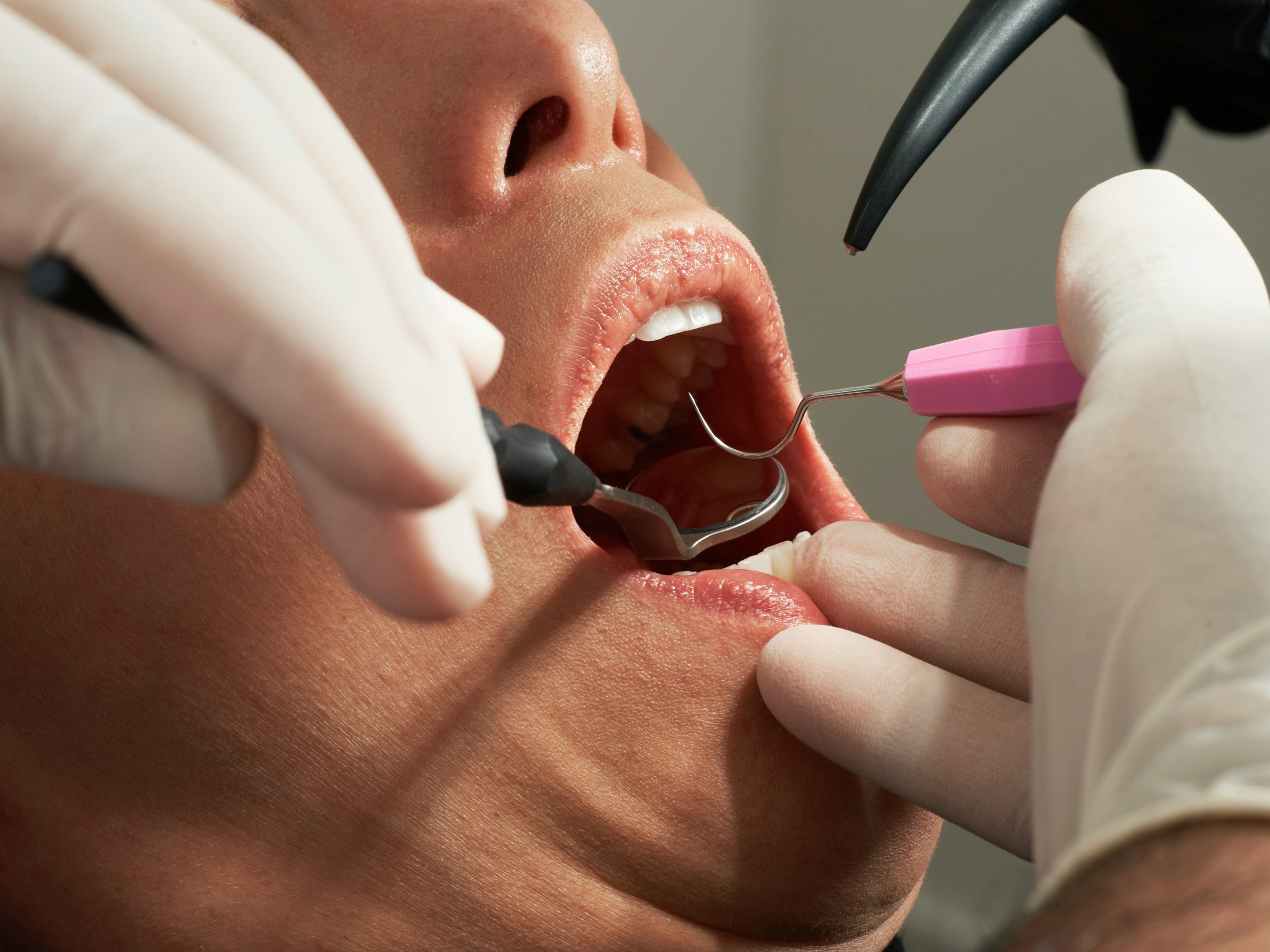alergias a materiales dentales