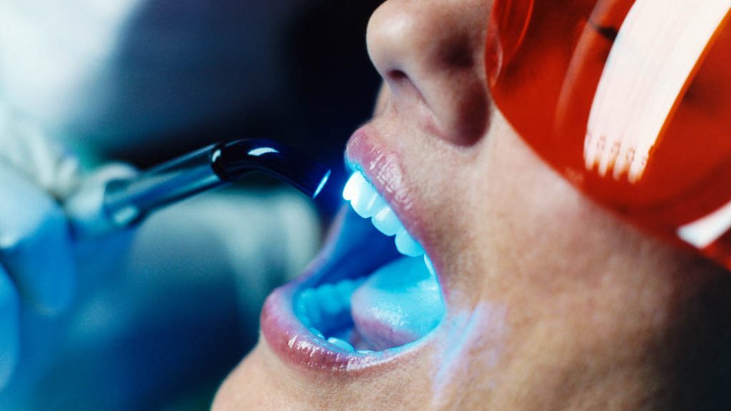 dentista blanqueamiento dental