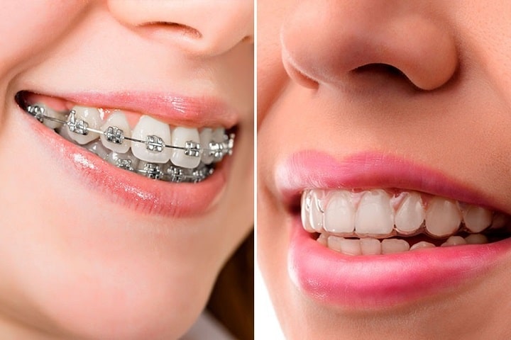 cuidar los dientes con ortodoncia invisibles o brackets