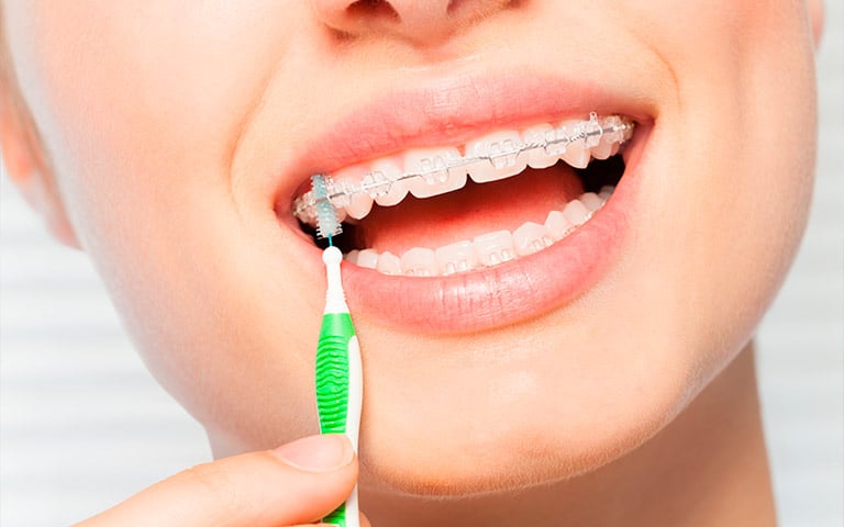 cómo cuidar los dientes con ortodoncia