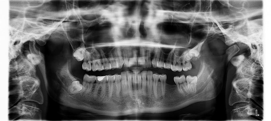 consecuencias de falta de muelas en clínica dental acedo