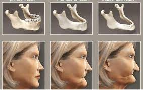 falta de muelas en clínica dental acedo