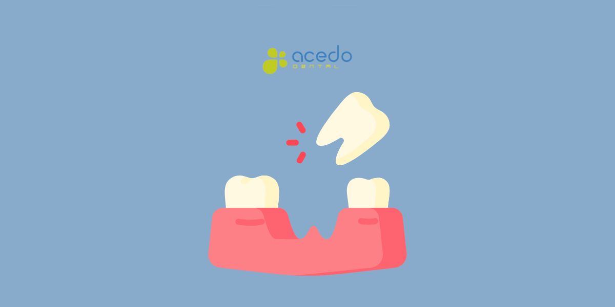 falta de muelas clínica dental acedo