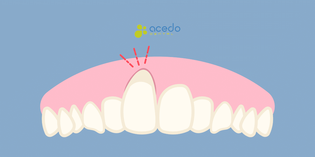 Blog encías retraídas en clínica dental acedo