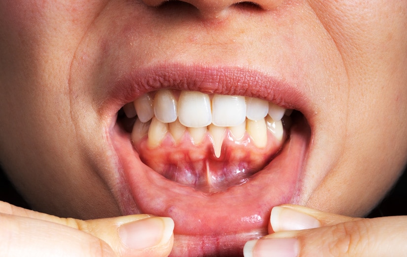 encías retraídas en clínica dental acedo