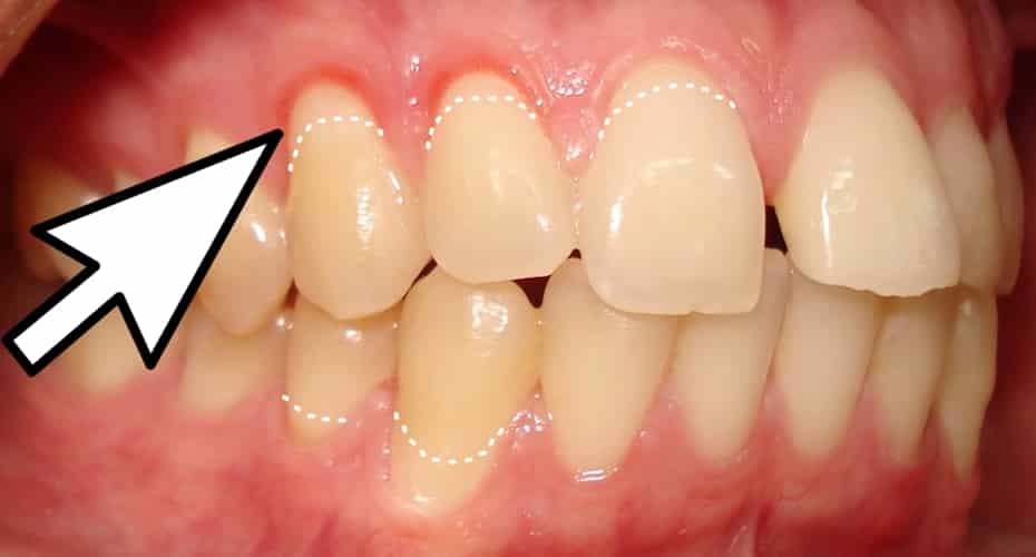 tratamiento encías retraídas en clínica dental acedo