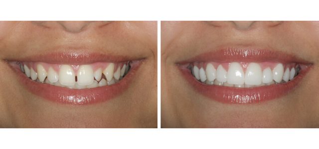 cambio carillas dentales acedo