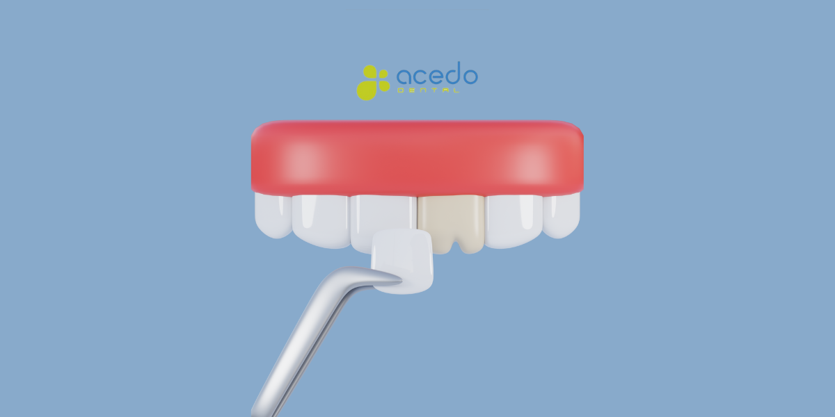 tipo de carillas dentales en acedo