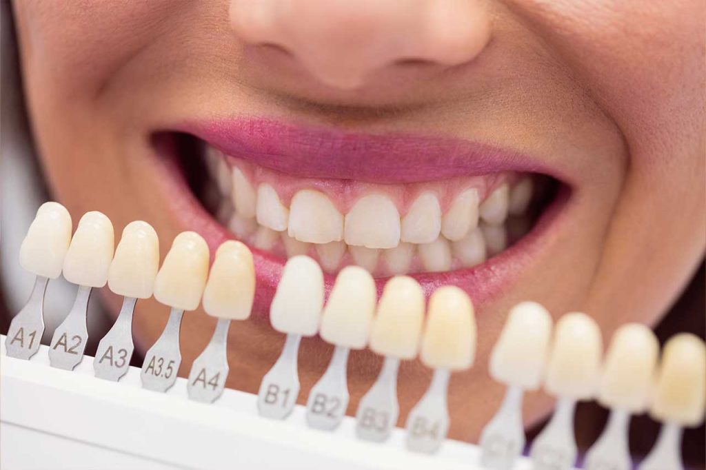 tipo de carillas dentales en clínica dental acedo