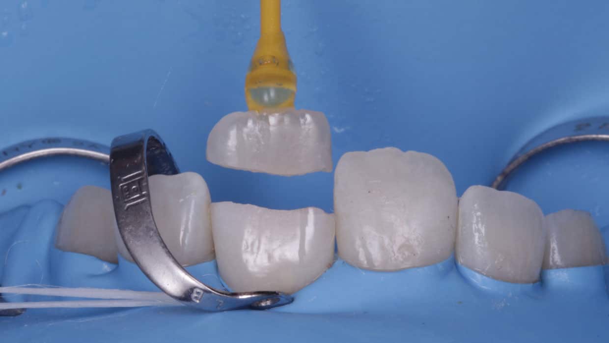 fractura dental