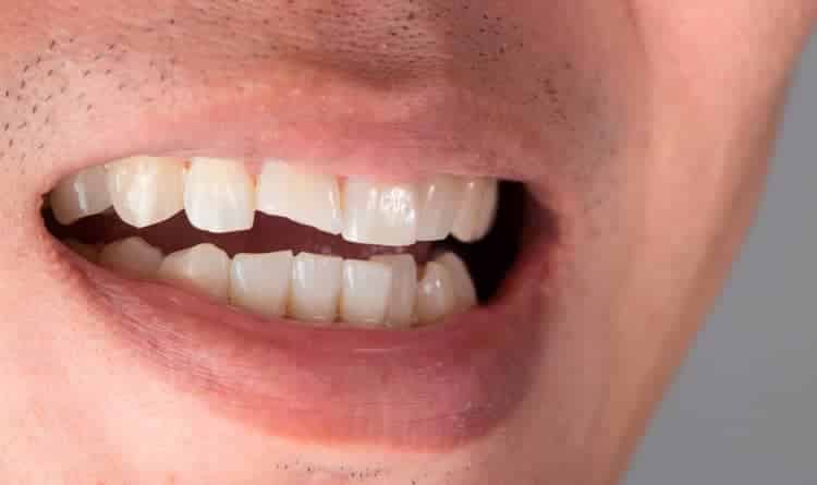 microfracturas dentales