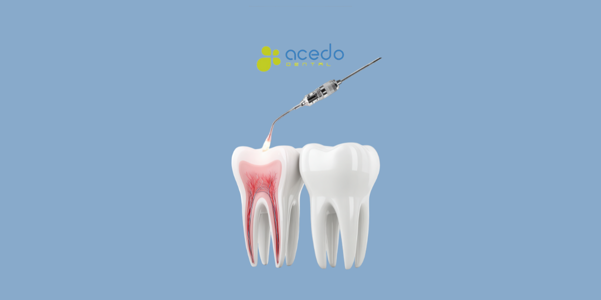 blog acedo endodoncia