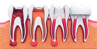 endodoncia acedo
