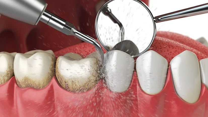 Limpieza dental en El Barco de Ávila