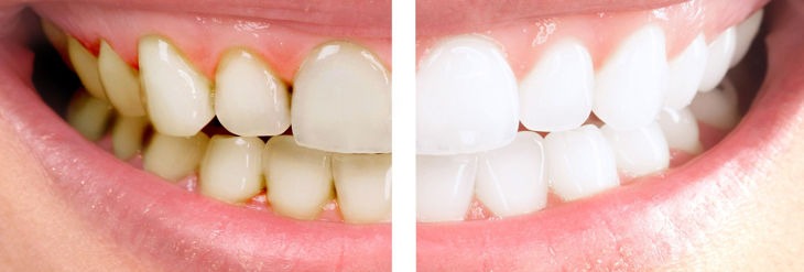 tinciones dentales