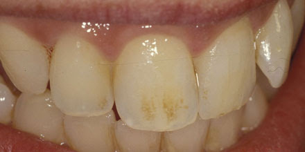 tratar las tinciones dentales en acedo dental