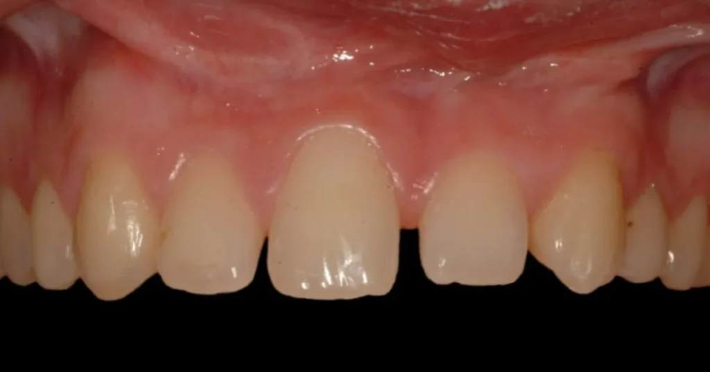 agenesia dental acedo