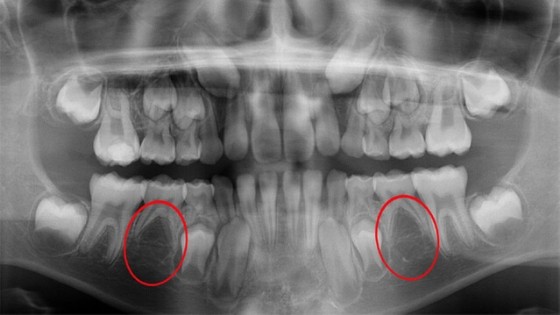 agenesia dental