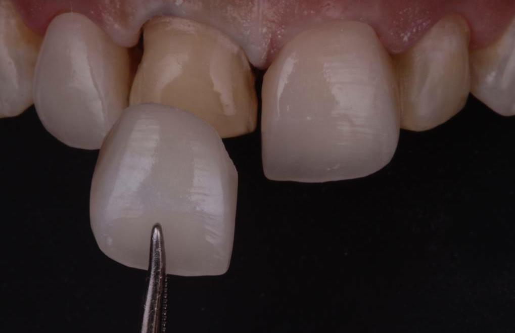 carillas dentales en seseña