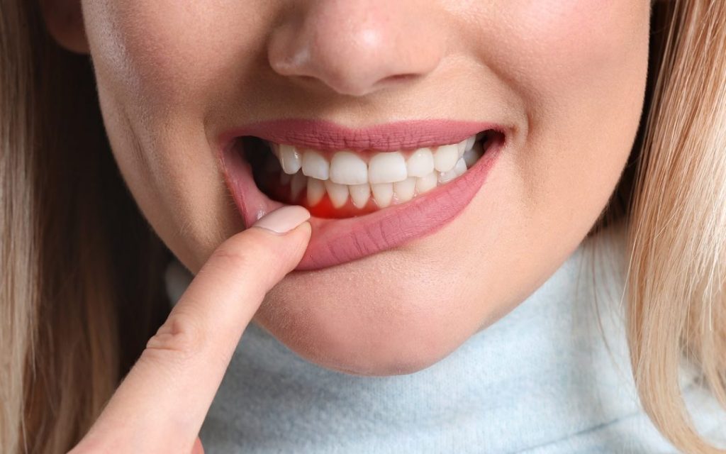 gingivitis