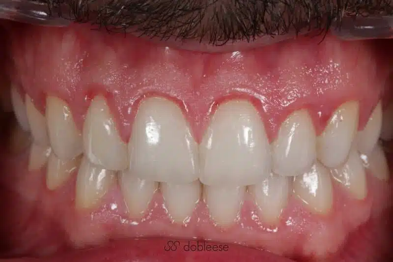 gingivitis